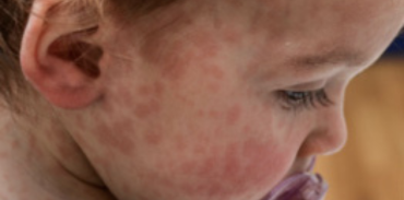 child with measles